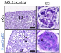 Mice develop kidney disease after deletion of KANSL2 in podocytes (below). Microscopic image of a 6-week-old kidney section. Severe glomerulosclerosis is observed (*, ROI), accompanied by damage in adjacent tissues (arrows) such as tubular dilatation.